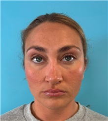 Rhinoplasty After Photo by Mark Markarian, MD, MSPH, FACS; Wellesley, MA - Case 49397