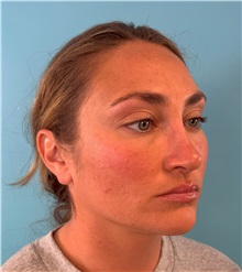 Rhinoplasty After Photo by Mark Markarian, MD, MSPH, FACS; Wellesley, MA - Case 49397