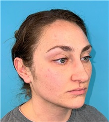 Rhinoplasty Before Photo by Mark Markarian, MD, MSPH, FACS; Wellesley, MA - Case 49397