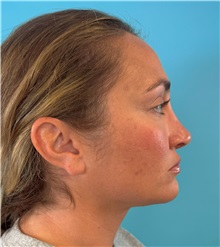 Rhinoplasty After Photo by Mark Markarian, MD, MSPH, FACS; Wellesley, MA - Case 49397