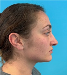 Rhinoplasty Before Photo by Mark Markarian, MD, MSPH, FACS; Wellesley, MA - Case 49397