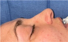 Rhinoplasty Before Photo by Mark Markarian, MD, MSPH, FACS; Wellesley, MA - Case 49397