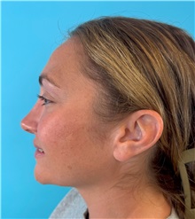 Rhinoplasty After Photo by Mark Markarian, MD, MSPH, FACS; Wellesley, MA - Case 49397