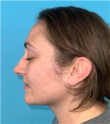 Rhinoplasty Before Photo by Mark Markarian, MD, MSPH, FACS; Wellesley, MA - Case 49397