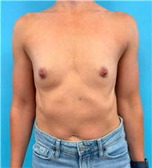 Breast Augmentation Before Photo by Mark Markarian, MD, MSPH, FACS; Wellesley, MA - Case 49402