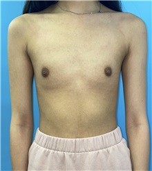 Breast Augmentation Before Photo by Mark Markarian, MD, MSPH, FACS; Wellesley, MA - Case 49845