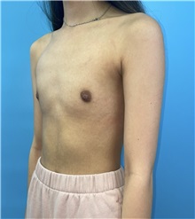 Breast Augmentation Before Photo by Mark Markarian, MD, MSPH, FACS; Wellesley, MA - Case 49845