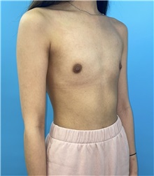 Breast Augmentation Before Photo by Mark Markarian, MD, MSPH, FACS; Wellesley, MA - Case 49845