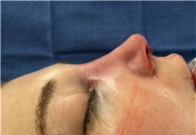 Rhinoplasty After Photo by Mark Markarian, MD, MSPH, FACS; Wellesley, MA - Case 49950