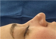 Rhinoplasty Before Photo by Mark Markarian, MD, MSPH, FACS; Wellesley, MA - Case 49950
