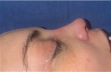 Rhinoplasty After Photo by Mark Markarian, MD, MSPH, FACS; Wellesley, MA - Case 49951 Rhinoplasty After Photo by Mark Markarian, MD, MSPH, FACS; Wellesley, MA - Case 49951