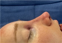 Rhinoplasty After Photo by Mark Markarian, MD, MSPH, FACS; Wellesley, MA - Case 49956 Rhinoplasty After Photo by Mark Markarian, MD, MSPH, FACS; Wellesley, MA - Case 49956