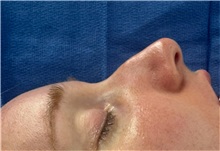 Rhinoplasty Before Photo by Mark Markarian, MD, MSPH, FACS; Wellesley, MA - Case 49956 Rhinoplasty Before Photo by Mark Markarian, MD, MSPH, FACS; Wellesley, MA - Case 49956