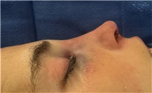 Rhinoplasty After Photo by Mark Markarian, MD, MSPH, FACS; Wellesley, MA - Case 49952 Rhinoplasty After Photo by Mark Markarian, MD, MSPH, FACS; Wellesley, MA - Case 49952