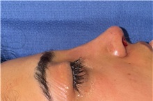 Rhinoplasty After Photo by Mark Markarian, MD, MSPH, FACS; Wellesley, MA - Case 49955 Rhinoplasty After Photo by Mark Markarian, MD, MSPH, FACS; Wellesley, MA - Case 49955