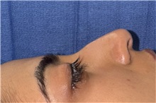 Rhinoplasty Before Photo by Mark Markarian, MD, MSPH, FACS; Wellesley, MA - Case 49955 Rhinoplasty Before Photo by Mark Markarian, MD, MSPH, FACS; Wellesley, MA - Case 49955