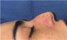 Rhinoplasty Before Photo by Mark Markarian, MD, MSPH, FACS; Wellesley, MA - Case 49958