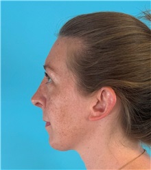 Rhinoplasty After Photo by Mark Markarian, MD, MSPH, FACS; ,  - Case 50150