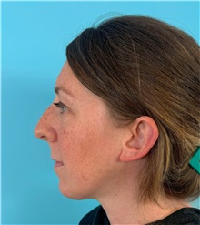 Rhinoplasty Before Photo by Mark Markarian, MD, MSPH, FACS; ,  - Case 50150