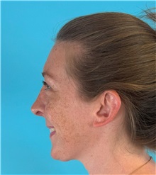 Rhinoplasty After Photo by Mark Markarian, MD, MSPH, FACS; ,  - Case 50150