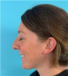Rhinoplasty Before Photo by Mark Markarian, MD, MSPH, FACS; ,  - Case 50150