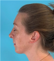 Rhinoplasty After Photo by Mark Markarian, MD, MSPH, FACS; ,  - Case 50150