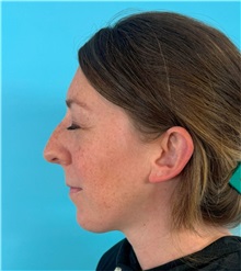 Rhinoplasty Before Photo by Mark Markarian, MD, MSPH, FACS; ,  - Case 50150
