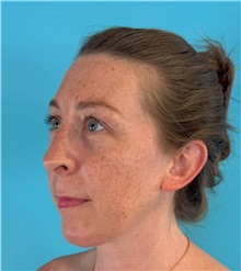 Rhinoplasty After Photo by Mark Markarian, MD, MSPH, FACS; ,  - Case 50150