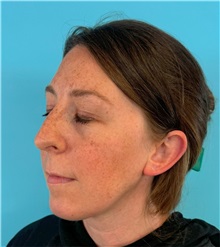 Rhinoplasty Before Photo by Mark Markarian, MD, MSPH, FACS; ,  - Case 50150