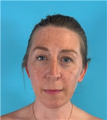 Rhinoplasty After Photo by Mark Markarian, MD, MSPH, FACS; ,  - Case 50150