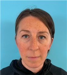 Rhinoplasty Before Photo by Mark Markarian, MD, MSPH, FACS; ,  - Case 50150