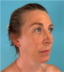 Rhinoplasty After Photo by Mark Markarian, MD, MSPH, FACS; ,  - Case 50150