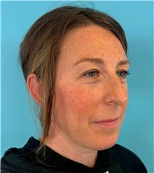 Rhinoplasty Before Photo by Mark Markarian, MD, MSPH, FACS; ,  - Case 50150