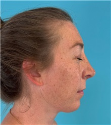 Rhinoplasty After Photo by Mark Markarian, MD, MSPH, FACS; ,  - Case 50150