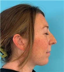 Rhinoplasty Before Photo by Mark Markarian, MD, MSPH, FACS; ,  - Case 50150