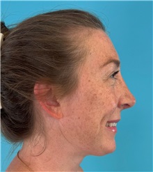 Rhinoplasty After Photo by Mark Markarian, MD, MSPH, FACS; ,  - Case 50150