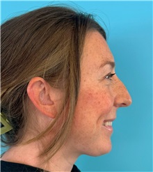 Rhinoplasty Before Photo by Mark Markarian, MD, MSPH, FACS; ,  - Case 50150