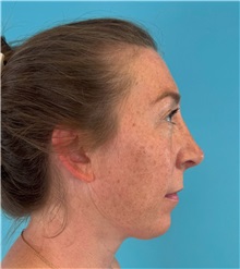 Rhinoplasty After Photo by Mark Markarian, MD, MSPH, FACS; ,  - Case 50150