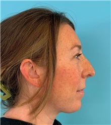 Rhinoplasty Before Photo by Mark Markarian, MD, MSPH, FACS; ,  - Case 50150