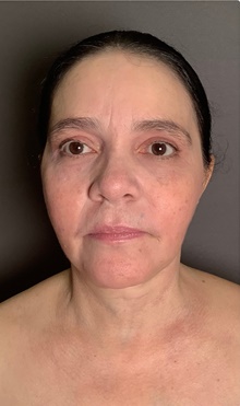 Neck Lift After Photo by Mark Albert, MD; New York, NY - Case 47981