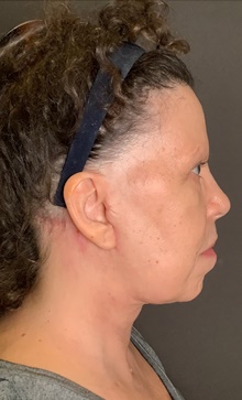 Neck Lift After Photo by Mark Albert, MD; New York, NY - Case 47982