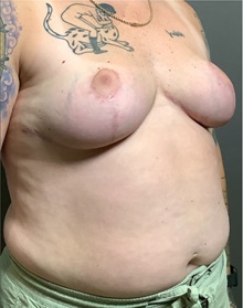 Breast Reduction After Photo by Mark Albert, MD; New York, NY - Case 47986