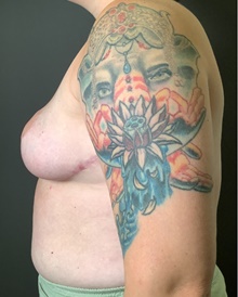 Breast Reduction After Photo by Mark Albert, MD; New York, NY - Case 47986