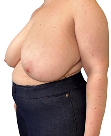 Breast Reduction Before Photo by Mark Albert, MD; New York, NY - Case 47990