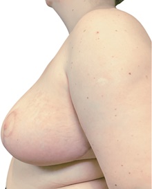 Breast Reduction After Photo by Mark Albert, MD; New York, NY - Case 47990