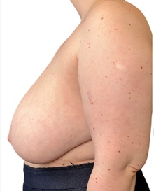 Breast Reduction Before Photo by Mark Albert, MD; New York, NY - Case 47990
