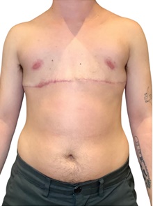Transmasculine Top Surgery After Photo by Mark Albert, MD; New York, NY - Case 47997