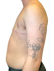 Transmasculine Top Surgery After Photo by Mark Albert, MD; New York, NY - Case 47997