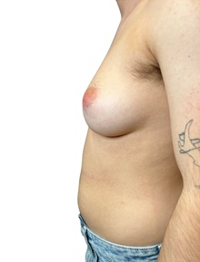 Transmasculine Top Surgery Before Photo by Mark Albert, MD; New York, NY - Case 47997