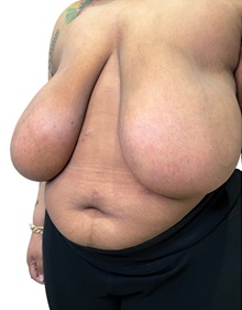 Breast Reduction Before Photo by Mark Albert, MD; New York, NY - Case 48004